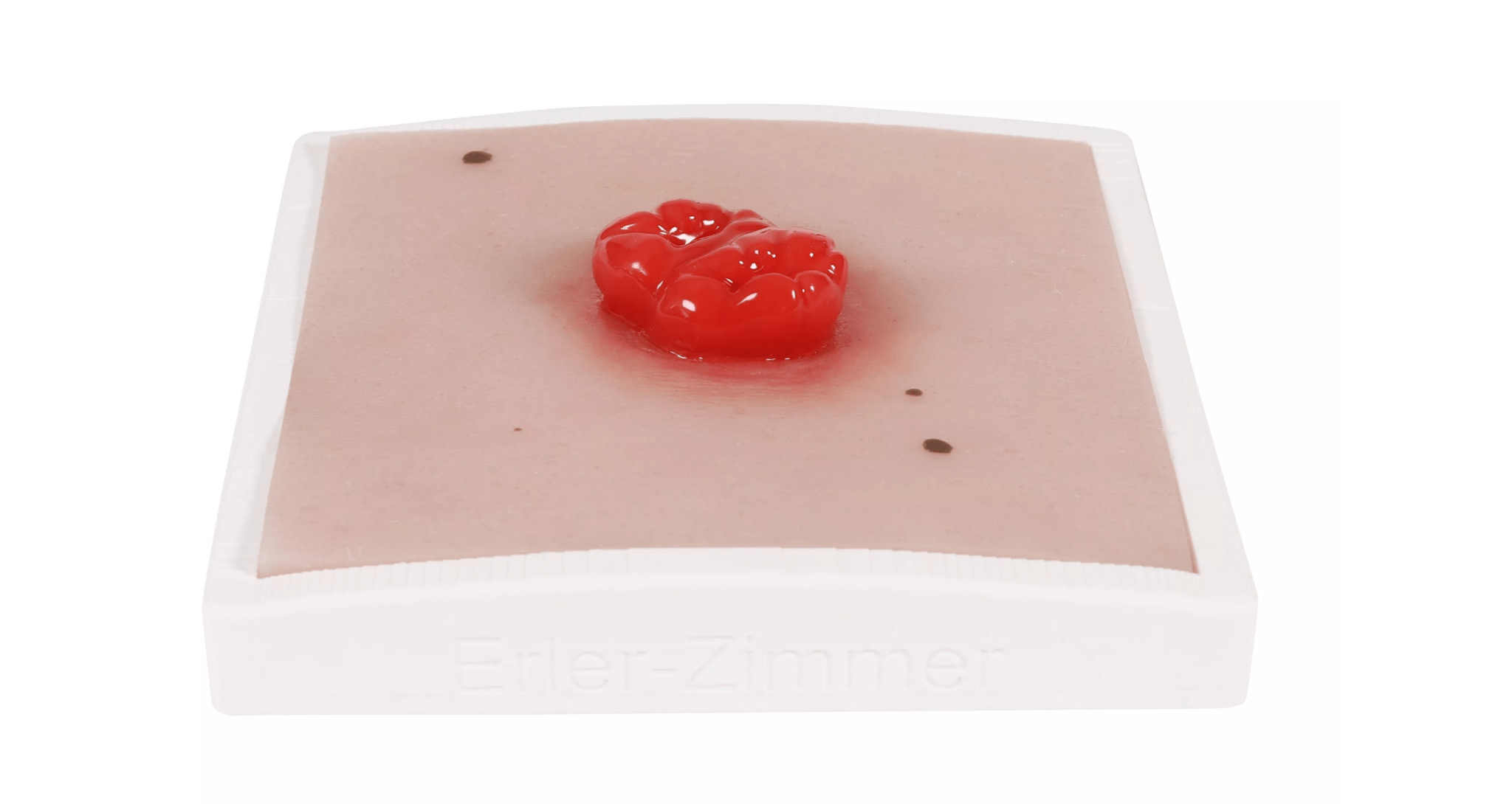 Wundmoulage Kolostoma doppelläufig - Erler - Zimmer